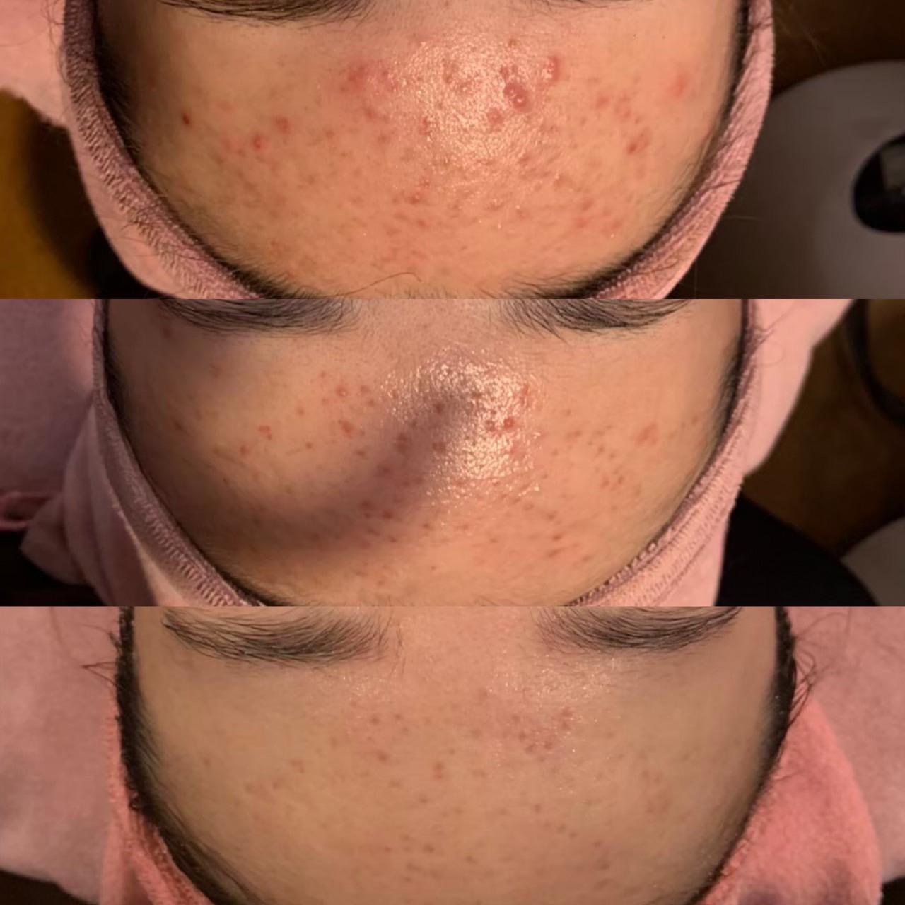 🤔ニキビでお悩みの方へ🌿