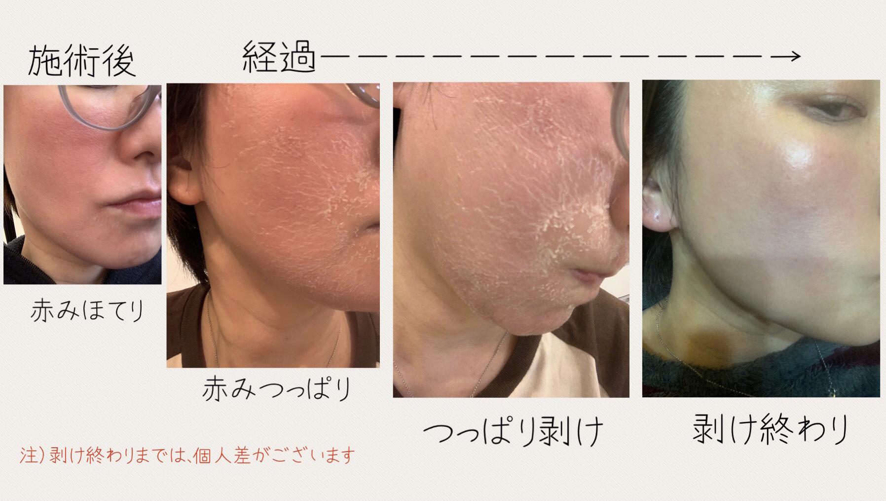 剥離ハーブ🌿新導入