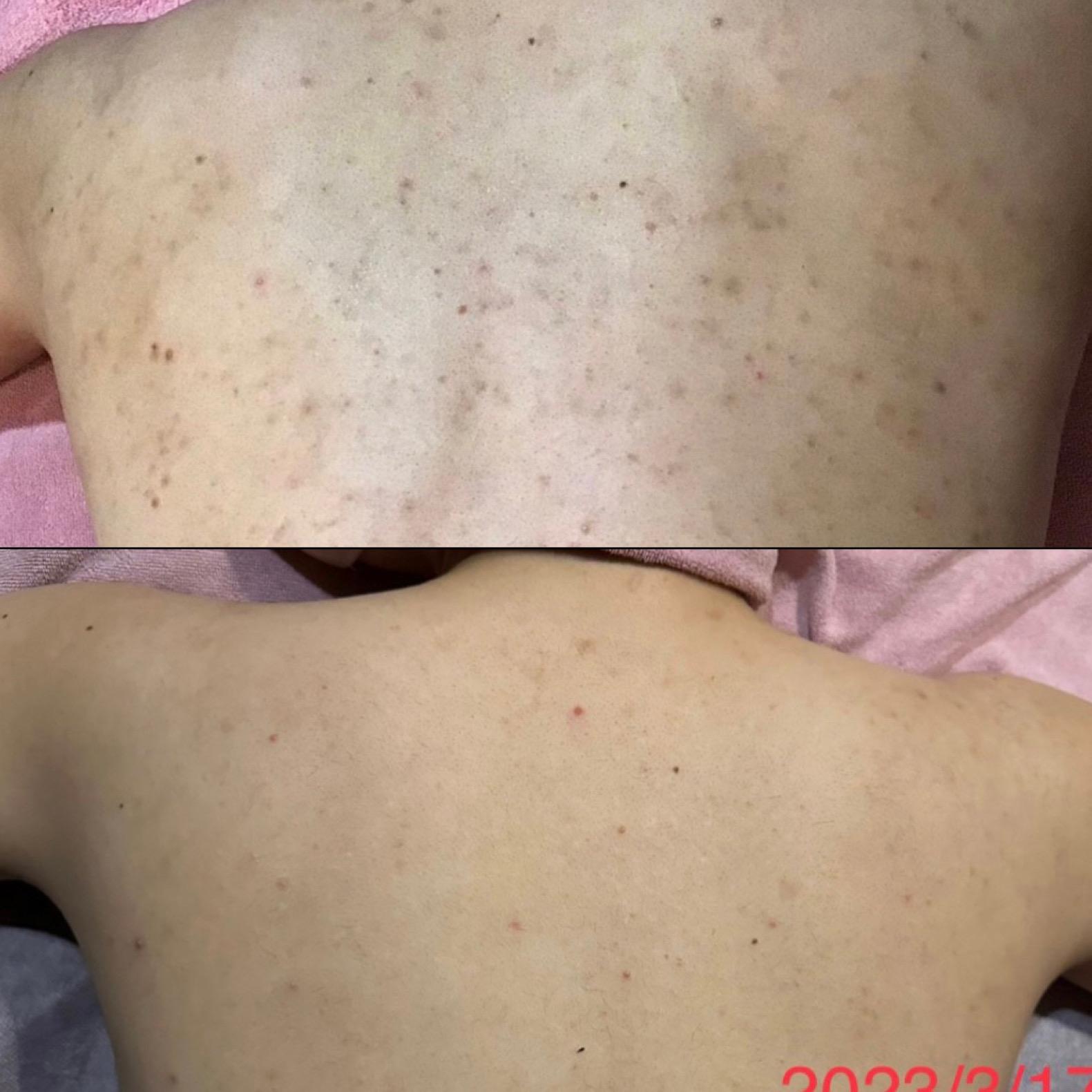 ﾋﾟｰﾘﾝｸﾞ/剥離ハーブ